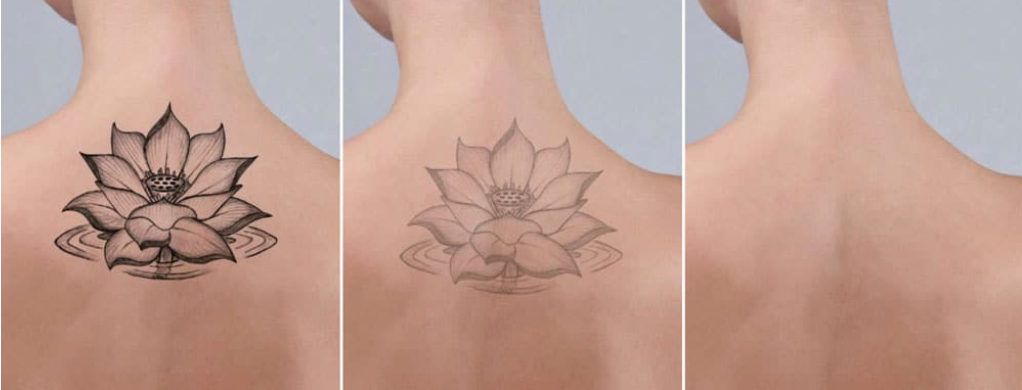 Trois photos d'une femme avec un tatouage qui disparait au fur et à mesure des séances de laser